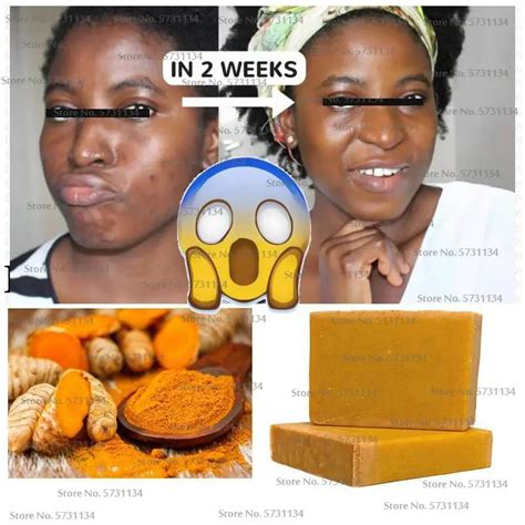 Tumeric Soap Natural To Lightening Acne Dark Spots Skin Glow Brighter