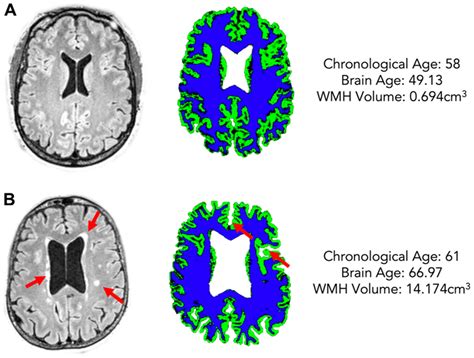 White matter hyperintensity load is associated with premature brain ...