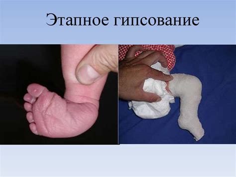Врожденная косолапость - online presentation