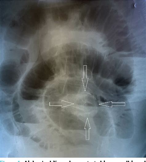 Figure From Gallstone Ileus Due To Cholecystoduodenal Fistula