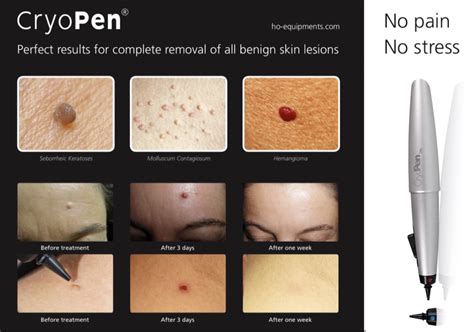 Cryopen Dr Kara Cosmetic Clinic Skincare Aesthetics Norwich