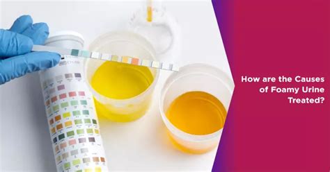 How Are the Causes of Foamy Urine Treated? | NOVA IVF