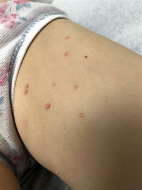 Molluscum Contagiosum Causes Symptoms And Treatment