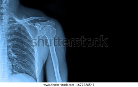 Xray Images Shoulder Joint See Injuries Stock Photo 1679226541 ...