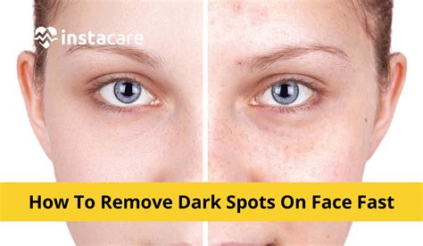 How To Remove Dark Spots On Face Fast Remove Dark Spots On Face Naturally And Fast Your Guide