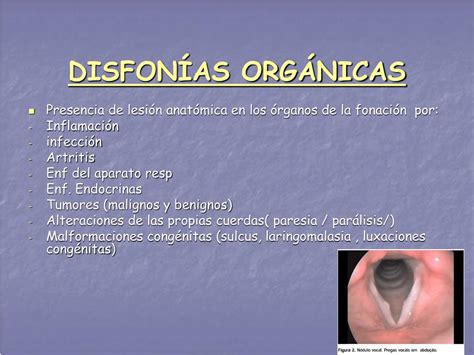 Ppt ClasificaciÃ³n De Las DisfonÃ­as Powerpoint Presentation Free