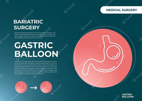 Balão gástrico de endoscopia de estômago dentro de uma cirurgia de ...