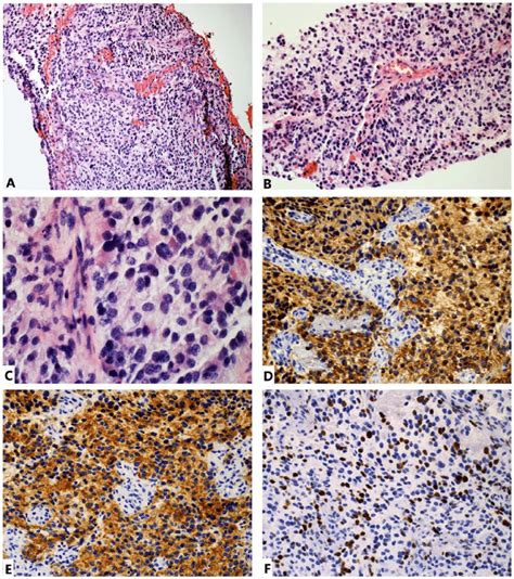 Histopathological And Immunohistochemical Characterization Of Tumor