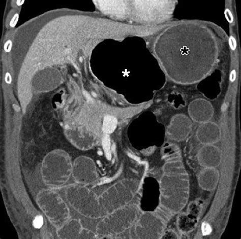 The Lesser Sac And Foramen Of Winslow Anatomy Embryology And Ct