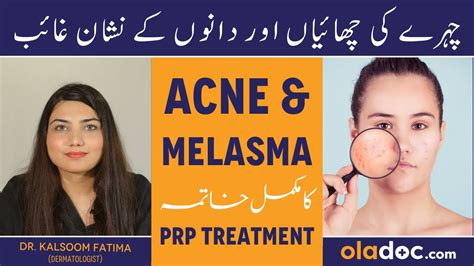 Prp For Melasma And Acne Chehre Ki Chaiyan Kaise Dur Karen How To