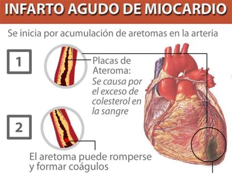 ¿cómo Se Produce Un Infarto Al Corazón Rpp Noticias