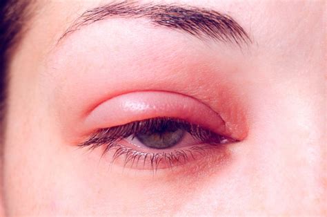 Blepharitis Lidrandentzündung Ursachen Symptome Therapie