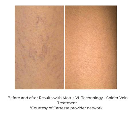 Motus AZ Pain Free Laser Hair Removal Treats All Skin Tones