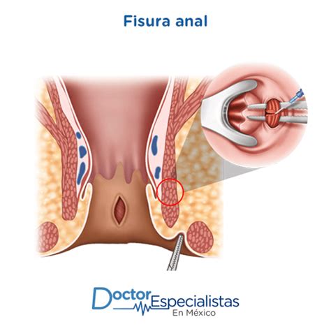 Mejores Cirujanos Para Fisuras Anales Doctor Especialistas