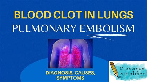 Pulmonary Embolism Blood Clot In Lungs Diagnosis Symptoms Causes