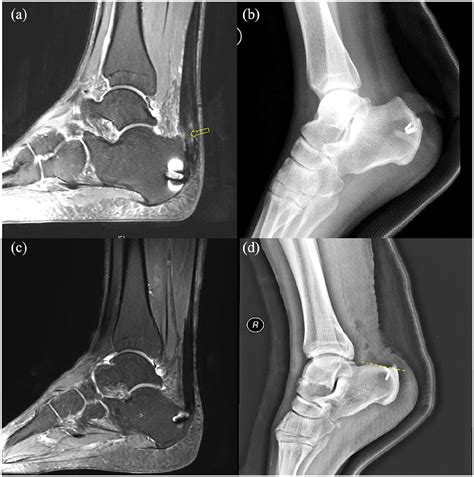 Insertional Achilles Tendonitis Mri