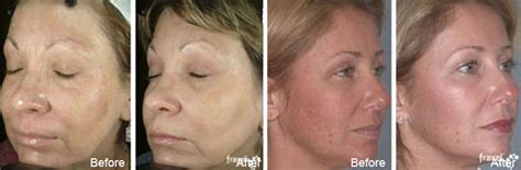 Fraxel Restore Dual Tm Treatments In New York