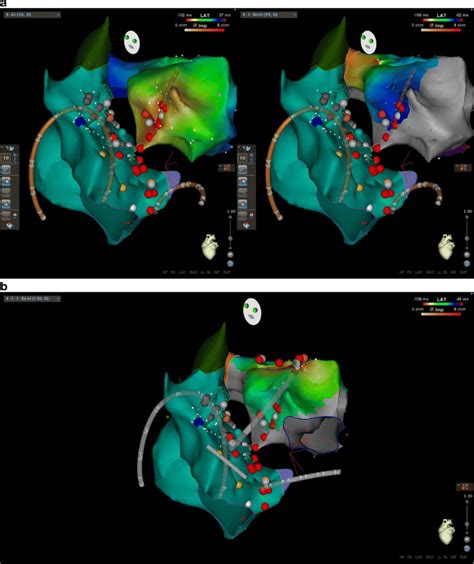 Electroanatomical Maps Of The Left Atrial Electrical Activation During