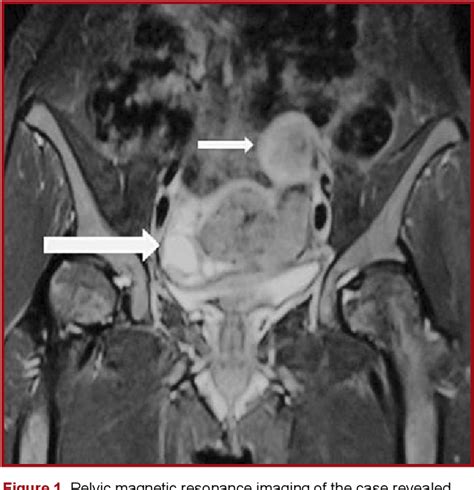 Figure 1 From Pelvic Endometriosis Presenting With Urinary Symptoms A Case Report Semantic