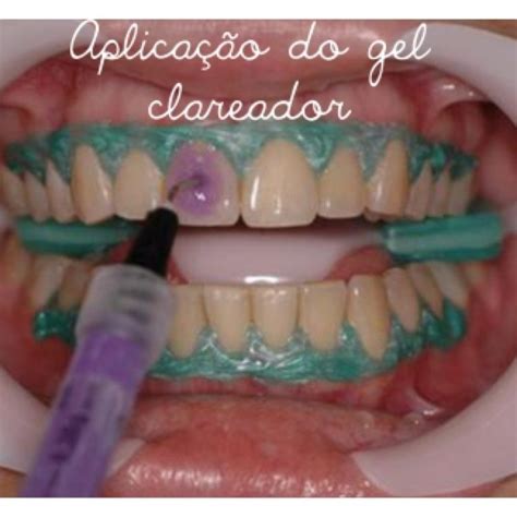 Clareamento Dental Caseiro Ou A Laser Qual O Melhor