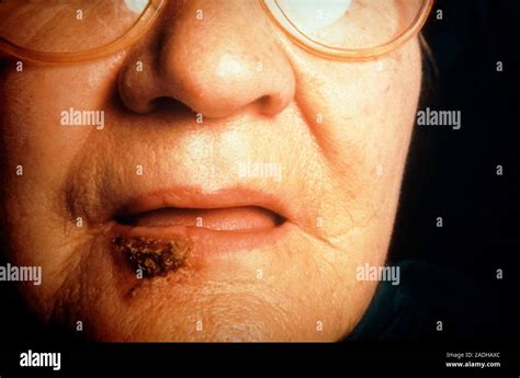 Squamous Cell Carcinoma Of The Lower Lip Stock Photo Alamy