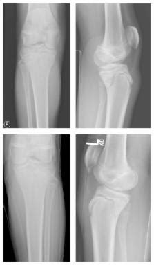 Bilateral Simultaneous Avulsion Fractures Of The Proximal Tibia In A 14