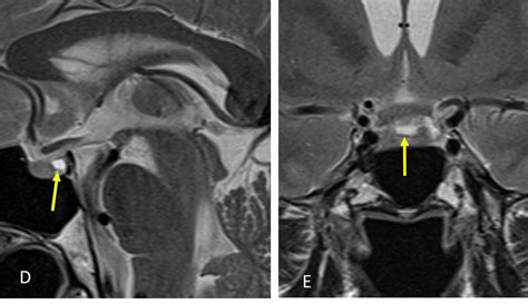 Rathke cleft cyst – Radiology Cases