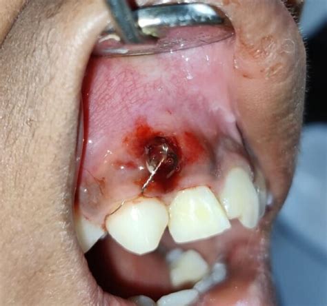 Management Of Infected Radicular Cyst Associated With Immature Maxillary Permanent Lateral