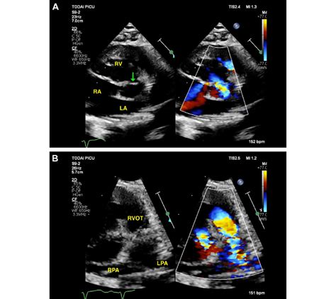 Preoperative Doppler Echocardiography A Parasternal Short Axis View