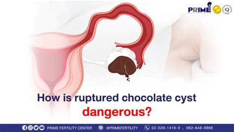 How is ruptured chocolate cyst dangerous? | ivf thailand