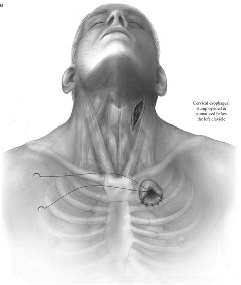 Surgical Management Of Esophageal Perforation Operative Techniques In