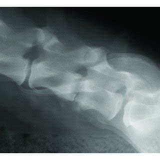 Lateral Radiographs Of The Lower Lumbar Spine Prior To A And After