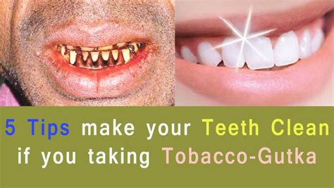 These 5 Tips Make Your Teeth Clean If You Taking Tobacco Gutka Teeth