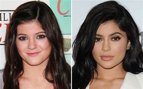 Kylie Jenner Antes Y Despu S De Cirug As Tiempo Hn Noticias De