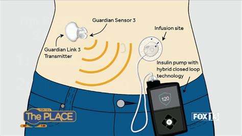 Jdrf Curing Type Diabetes