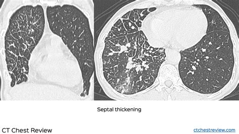 Case 4 Lymphangitis Carcinomatosis