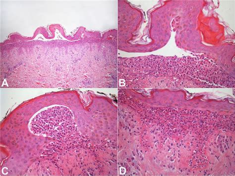 Bsle Skin Histopathology A Subepidermal Cleavage With Neutrophils Download Scientific