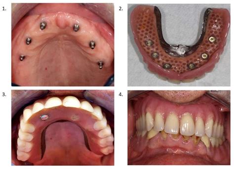 Jcm Free Full Text Comparing Masticatory Performance Of Maxillary