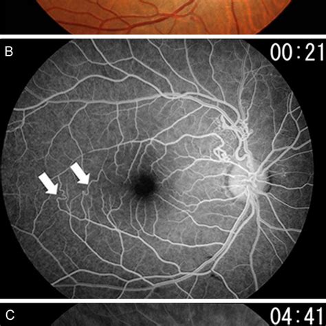 Fundus Photograph A And Fluorescein Angiogram B Of The Right Eye