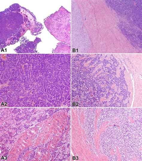 Small Cell Carcinomas Of The Urinary Bladder And Prostate Tert