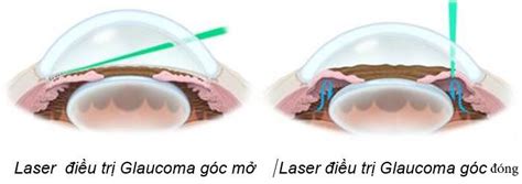 Nguy N Nh N V C Ch I U Tr B Nh C M N C Glaucoma