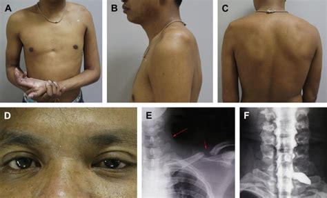 Adult Brachial Plexus Injury Musculoskeletal Key