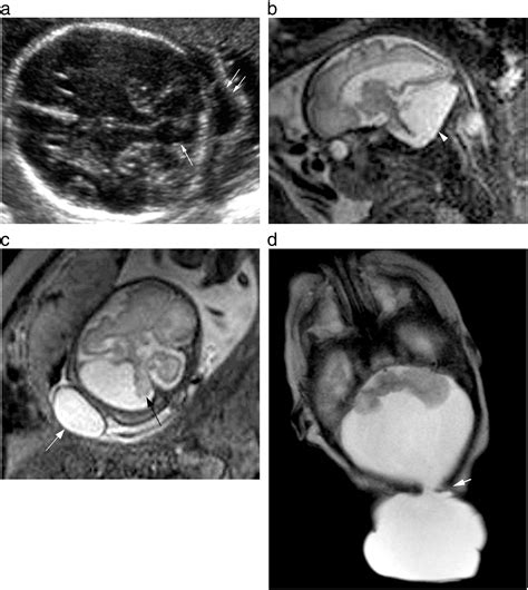 Diagnostic Imaging Of Posterior Fossa Anomalies In The Fetus And