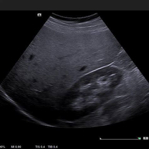 Liver Echogenicity Greater Than That Of The Kidney Download