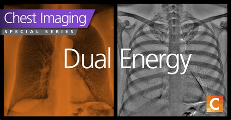 A Guide To Mobile Chest X Rays For Thoracic And Cardiac Care