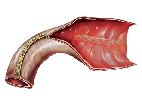 Terminal Ileum 1 Photograph By Asklepios Medical Atlas Fine Art America