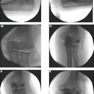 Anteroposterior Radiograph Of The Left Elbow Joint Showing Elbow