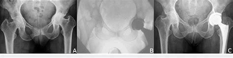 Protrusio Acetabuli Managed With The Direct Anterior Approach And