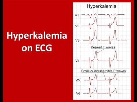 Hyperkalemia Effect On Heart Raised Potassium Hyperkalemia Ecg