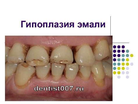 Гипоплазия эмали l Гипоплазия лат hypoplasia